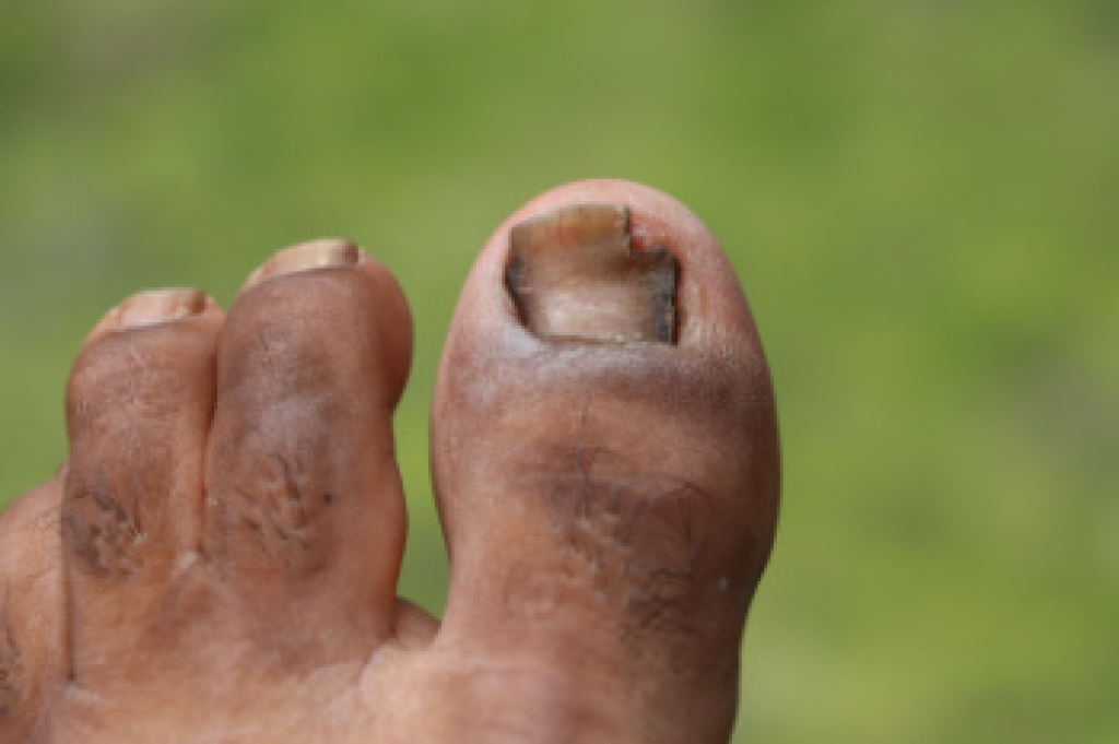 Causes of Toenail Discoloration and When Fungus Is to Blame