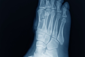 Cuboid Syndrome in Athletes