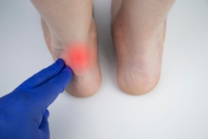 Recovering From an Achilles Tendon Tear
