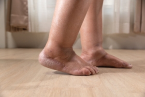 Swollen Feet and the Role of Edema